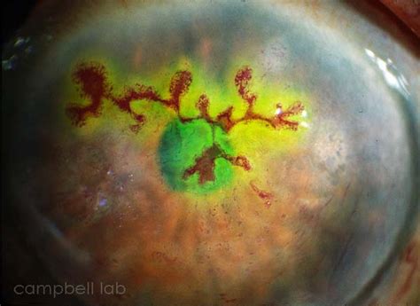 Herpes Simplex Virus, Lab Diagnostic Testing, The Charles T. Campbell Eye Microbiology Lab, UPMC ...