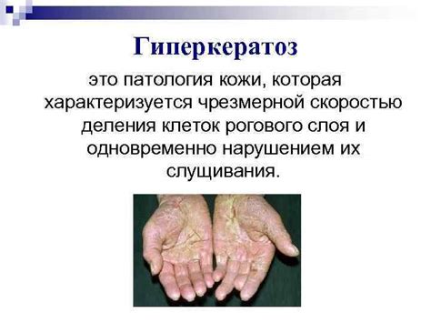 СУХОСТЬ КОЖИ ГИПЕРКЕРАТОЗЫ Гиперкератоз это патология кожи