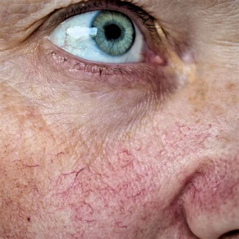 Makeup To Hide Red Veins On Face | Saubhaya Makeup