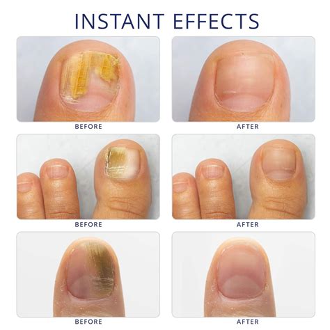 Buy Nail Fungus Treatment for Toenail, Toenail Fungus Treatment, Toe