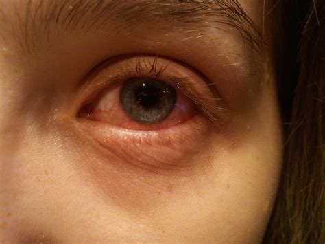 Conjunctivitis (Pink Eye) Causes, Symptoms & Treatment