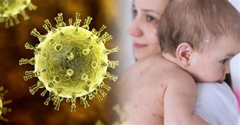 Chickenpox myths dispelled as experts call for toddlers to get vaccine ...