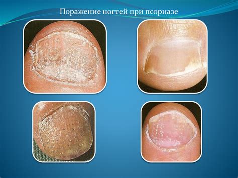 5_Лекция_псориаз,_красный_плоский_лишай - презентация онлайн
