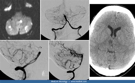 Basilar artery stroke | MedLink Neurology