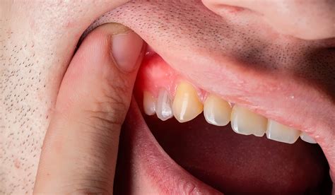dental abscess  symptoms  prevention