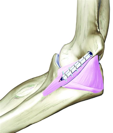 Ulnar Collateral Ligament Rehabilitation