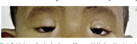 Blepharophimosis Ptosis Epicanthus Inversus Syndrome Or Bpes