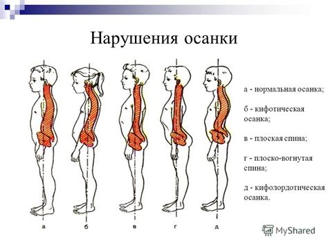 Презентация на тему: "Нарушения осанки у школьников Выполнила: Ученица ...