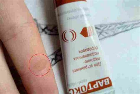 Мазь від бородавок: яку вибрати? — UA Magazine Україна