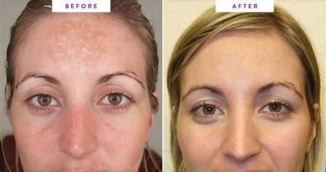How Long Before You Can Wear Makeup After Microdermabrasion - Mugeek ...