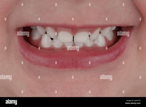 Milk teeth hi-res stock photography and images - Alamy