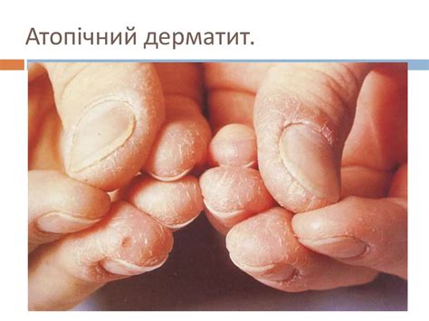 Атопічний дерматит - online presentation