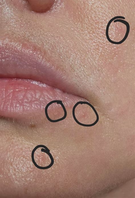 small pimples  mouth nose  cheeks rmedicaladvice