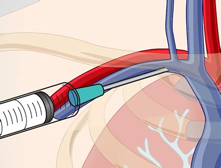 Catheter Insertion in Subclavian Vein | Emergency Medicine and Critical ...