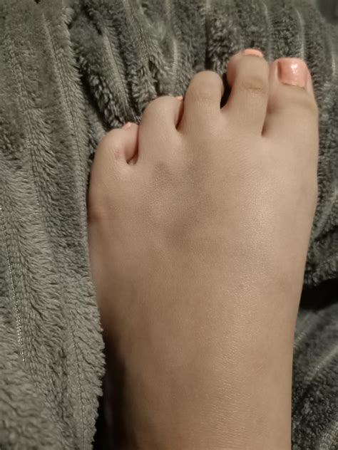 a bruise on my foot shaped like a star : r/mildlyinteresting