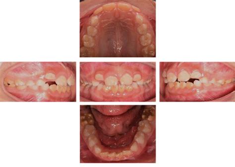 Initial intra-oral photographs. | Download Scientific Diagram