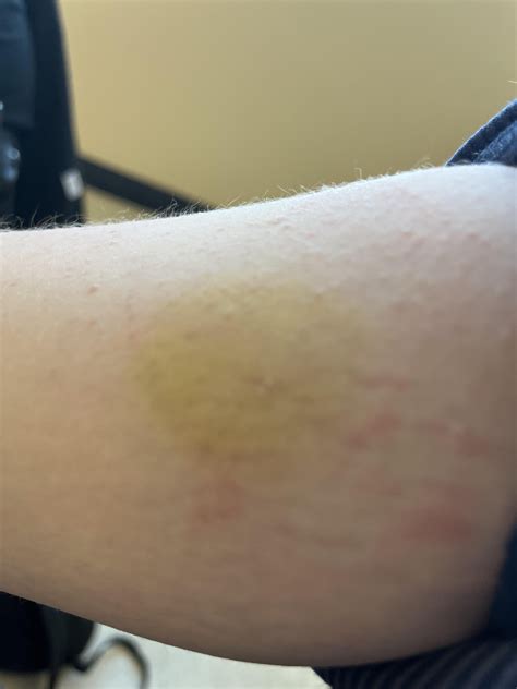 This yellow spot on my arm it used to be a lot smaller and purple : r