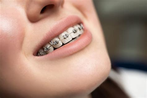 invisalign  ceramic braces