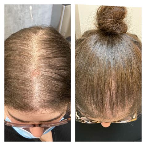 exosomes for hair loss 1
