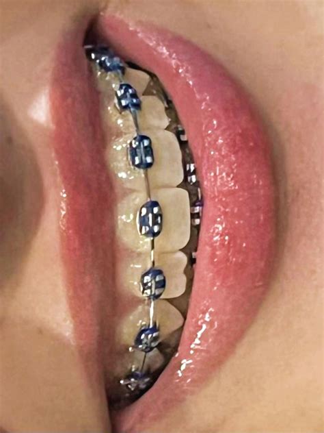 braces colors ideas   braces colors braces teeth braces
