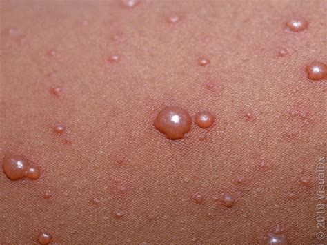 chickenpox  darker skin tones images  treatment goodrx