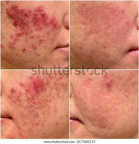 how to fix ice pick scars