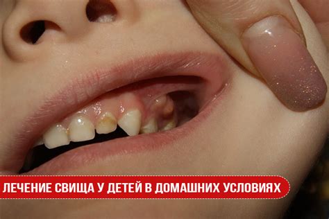Лечение свища у детей в домашних условиях | Статьи стоматологии в Николаеве