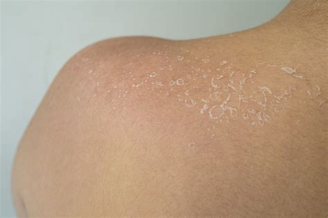 Dry Skin Info Page – Cause, Types and Treatments