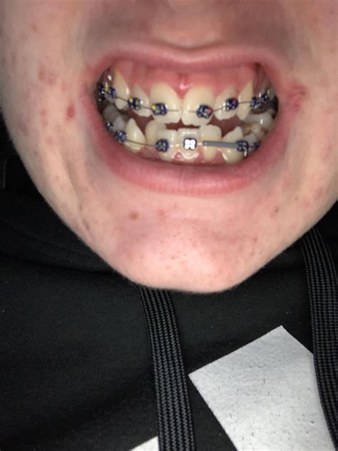 Did my orthodontist do a good job on my braces? don’t mind the acne