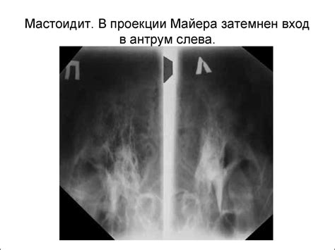 Мастоидит, его формы. Отоантритов, классификация, диагностика и лечение ...