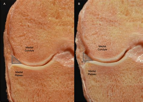 cadaveric representation  intact medial meniscus posterior root
