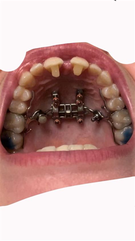 MSE before and after INSANE : r/orthotropics