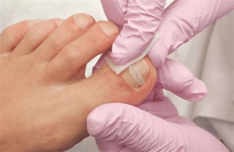 What Is An Ingrown Toenail | Valley Foot Care, Inc.