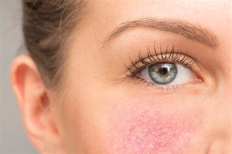 rosacea   trattamento acne rosacea   rimedi naturali