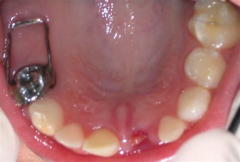 Zapatilla distal mantenedor de espacio | Bucanero Calzados