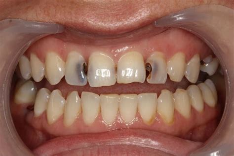 Кариес: фото - что такое кариес и как он выглядит