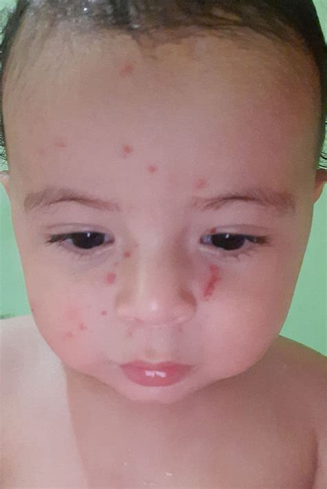 Bolinhas No Rosto Do Bb - Bebe com bolinhas (??) No rosto | BabyCenter