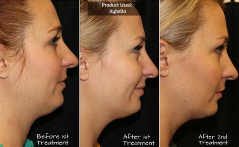kybella treatment chandler az    neck lift