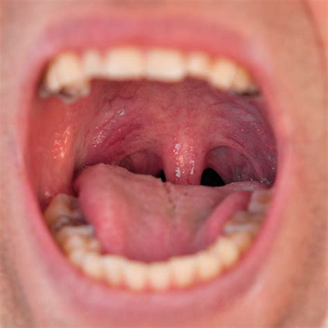 Clamidia Na Garganta Dor De Garganta: Conhecendo As Causas E