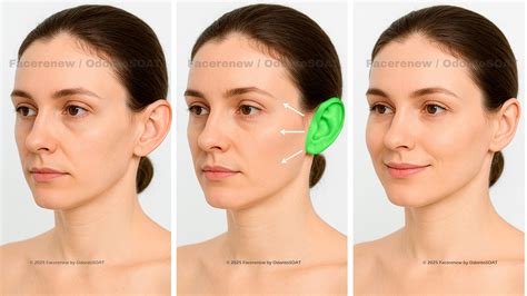 otoplasty  cali colombia aesthetic ear surgery