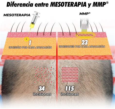 Mmp Capilar Antes E Depois - MMP Capilar- Microinfusión de medicamentos en la piel - Clínicas Dr.Pelo