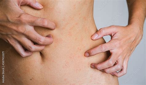 Psoriasis skin disease is a dermatic problem, red allergic skin rash. Stock Photo | Adobe Stock