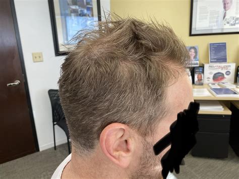 Too early or perfect time for HT? Rough # of grafts? On minox but don’t