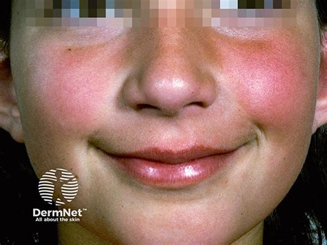 Erythema Infectiosum Images