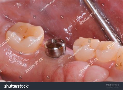 healing abutment   images shutterstock