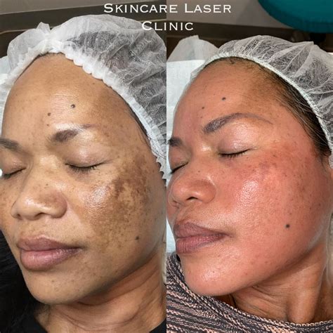Pico laser – Skincare Laser Clinic