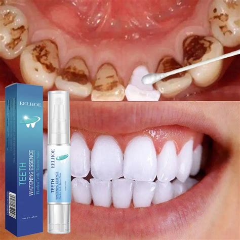 Отбеливающая ручка для отбеливания зубов | AliExpress