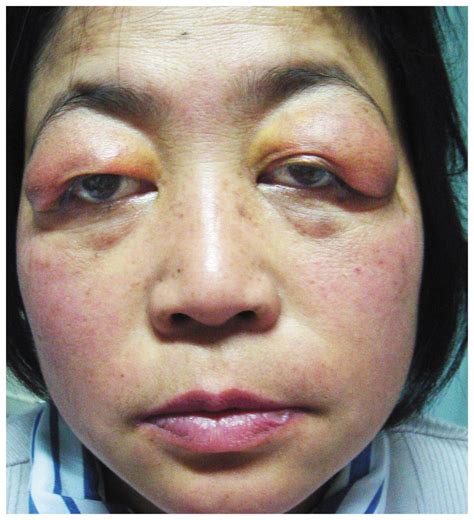 Slipping rib syndrome – Artofit