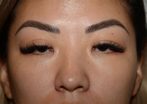 Double Eyelid #1379 - Amadi Aesthetics | Plastic Surgery & Med SPA