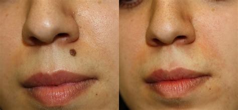 benefits  mole removal surgery fallen scoop